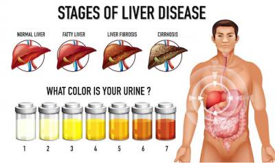 Liver Cirrhosis treatment cost in India
