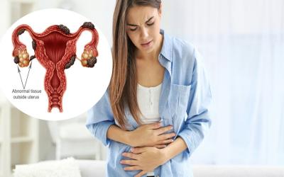 Endometriosis treatment in Mumbai