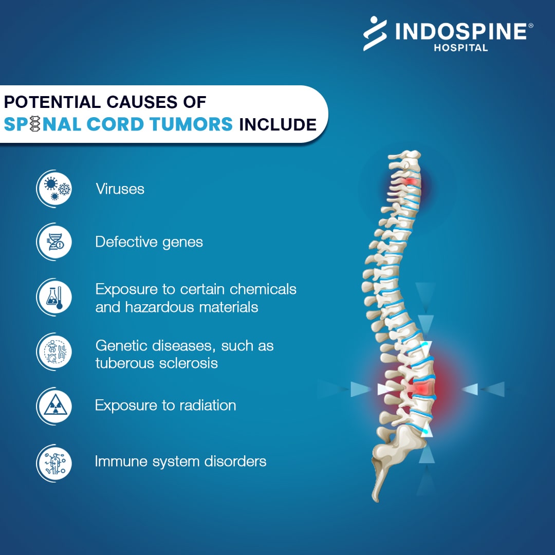 Best Hospital for Spinal Tumor Surgery in Ahmedabad