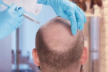 Get Your Hair Back! FUE Hair Transplant in the UK - Leeds Health, Personal Trainer