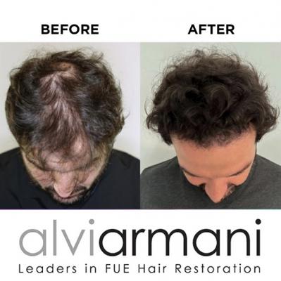 Restoring Confidence Hair Implants in Cape Town