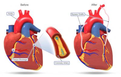 Coronary Artery Bypass Surgery in India