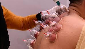 Hijama: Supporting the Body's Natural Healing Processes