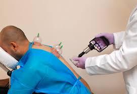 Hijama and Sports Performance: Enhancing Recovery