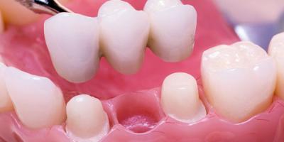 The Best Cost for Tooth Implants in India