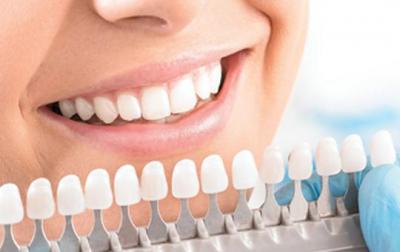 Best Teeth Whitening Service Doctors in Ahmedabad | 9825158578