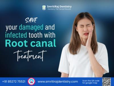 laser root canal treatment in Delhi