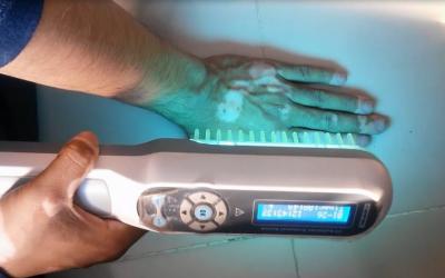 Effective Treatment of Psoriasis with Narrow-Band Uvb Phototherapy in Faridabad | Best Skin Speciali - Delhi Other