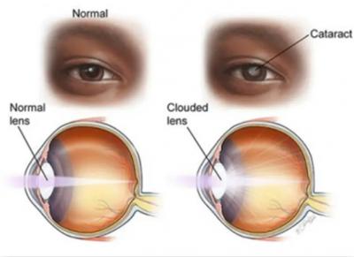 Cataract Removal Surgery