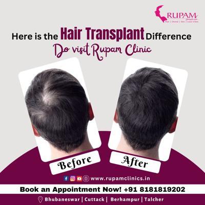 Rupam Clinic: Best Hair Transplant Clinic in Bhubaneswar