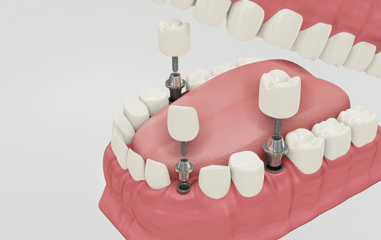Dr. Manish Shah dental Implants in Ahmadabad | 9825158578