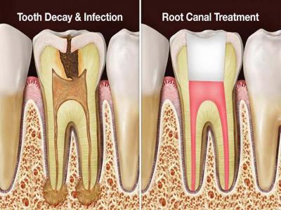 Painless Root Canal Treatment Procedure at Oneaesthetics dental clinic - Gurgaon Other