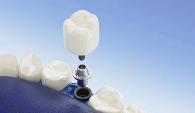 Best Dental Clinic for Implants - SummervilleDental - Other Other