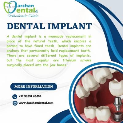Dental implant clinic | Best Dental implant clinic Kanyakumari - Chennai Professional Services