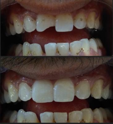 Enhance Your Smile with Ceramic Crowns and Bridges in Deccan, Pune: Microdent Dentistry - Pune Health, Personal Trainer
