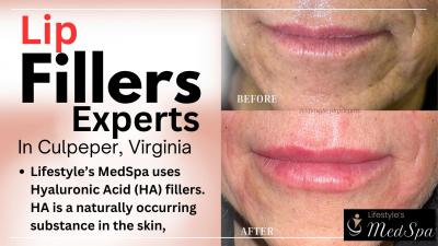 Lip Filler Experts in Culpeper at Lifestyle Physicians Aesthetics - Virginia Beach Health, Personal Trainer