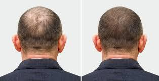 hair patches in hyderabad - Hyderabad Health, Personal Trainer