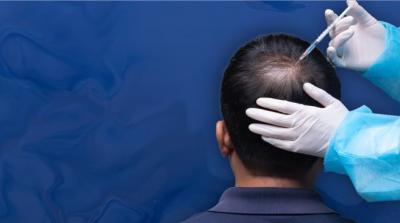 Top Hair Loss Treatments in Chennai at Kosmoderma