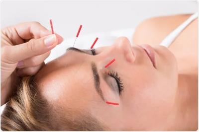 Acupuncture Treatments in London - Holistic Pain Relief and Wellness