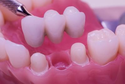 Best Dental bridge treatments clinic in Dubai UAE - Dubai Health, Personal Trainer