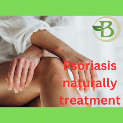 Get rid of skin psoriasis and scalp psoriasis naturally and permanently - Gurgaon Health, Personal Trainer