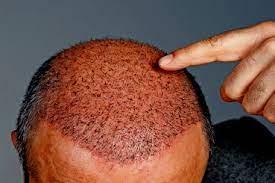 FUE Hair Transplants: The Top Three Advantages You Need to Know - Delhi Health, Personal Trainer