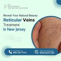 Reticular Veins Treatment in NJ - Other Health, Personal Trainer
