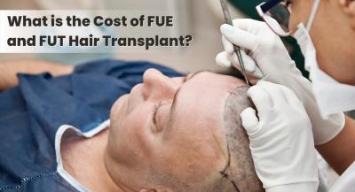 Understanding the Cost of FUE and FUT Hair Transplant