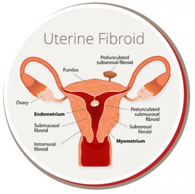 Giant Clots During Period: Causes, Symptoms, and Treatment | USA Fibroid Centers