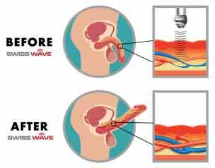 Acoustic Wave Ed Treatment - Sacramento Health, Personal Trainer