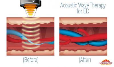 Acoustic Wave Ed Treatment - Sacramento Health, Personal Trainer