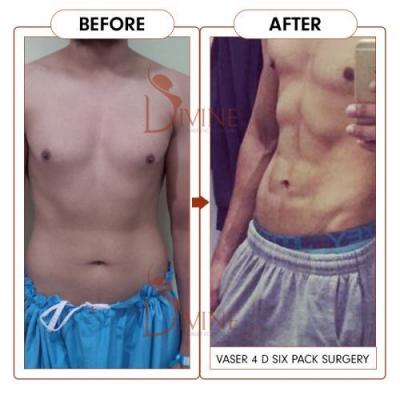 Six Packs Surgery For Men In Delhi