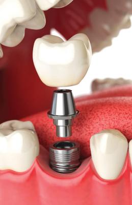 Best dental Implants clinic in Perris | Dentist in Perris | Nuevo