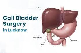 Expert Gall Bladder Surgery Services in Your City - Lucknow Health, Personal Trainer