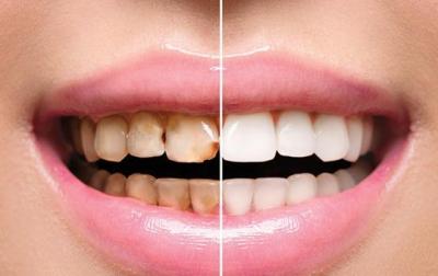 Full Mouth Rehabilitation| Aashu dental | 9825158578