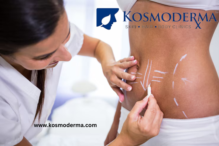 Lipodissolve Experts Belly Fat Reduction in Delhi by Kosmoderma 