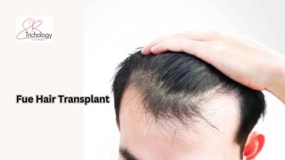 FUE Hair Transplant In Gurgaon - SB Trichology