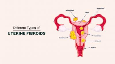 Understanding Different Types of Uterine Fibroids - Delhi Health, Personal Trainer