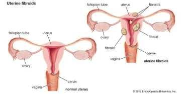 Key Causes of a Swollen Uterus Explained