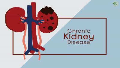 Kidney Failure Treatment Without Dialysis: Alternative Medication - Gurgaon Health, Personal Trainer