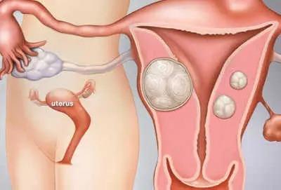 Fibroid Size Chart: A Comprehensive Visual Guide | Visit Us at USA Fibroid Centers