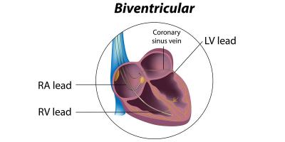 Enhance Cardiac Function with Advanced Ventricular Resynchronization Battery Technology