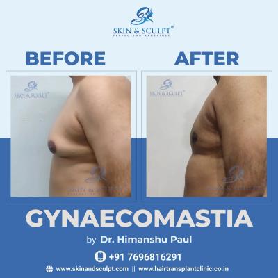 Top Gynecomastia Treatment in Chandigarh: Expert Solutions for Lasting Results