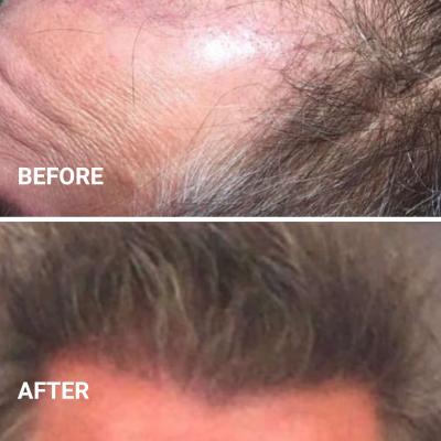 Best Hair transplant surgery in New York | MyHairNY.com - New York Health, Personal Trainer