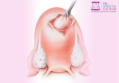 Best Myomectomy Surgery in Whitefield Manipal
