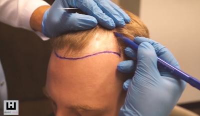 Get Your Confidence Back with a Hair Transplant in Turkey - Leeds Health, Personal Trainer
