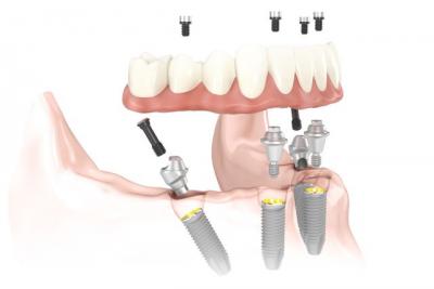 All on 4 Dental Implants Cost in India - Gurgaon Health, Personal Trainer