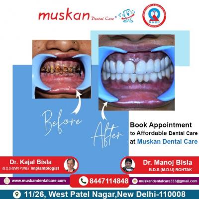 Best Dental Clinic in New Delhi |  9958822991 - Muskan Dental Care 