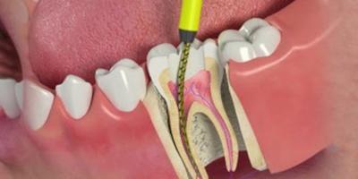 Painless Root Canal Treatment in India - Mumbai Health, Personal Trainer