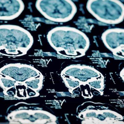 Brain Injury Lawyer in Seattle